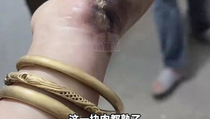手被烧熟!金手镯被烧熔!女子给电动车充电,不慎碰到充电口受伤
